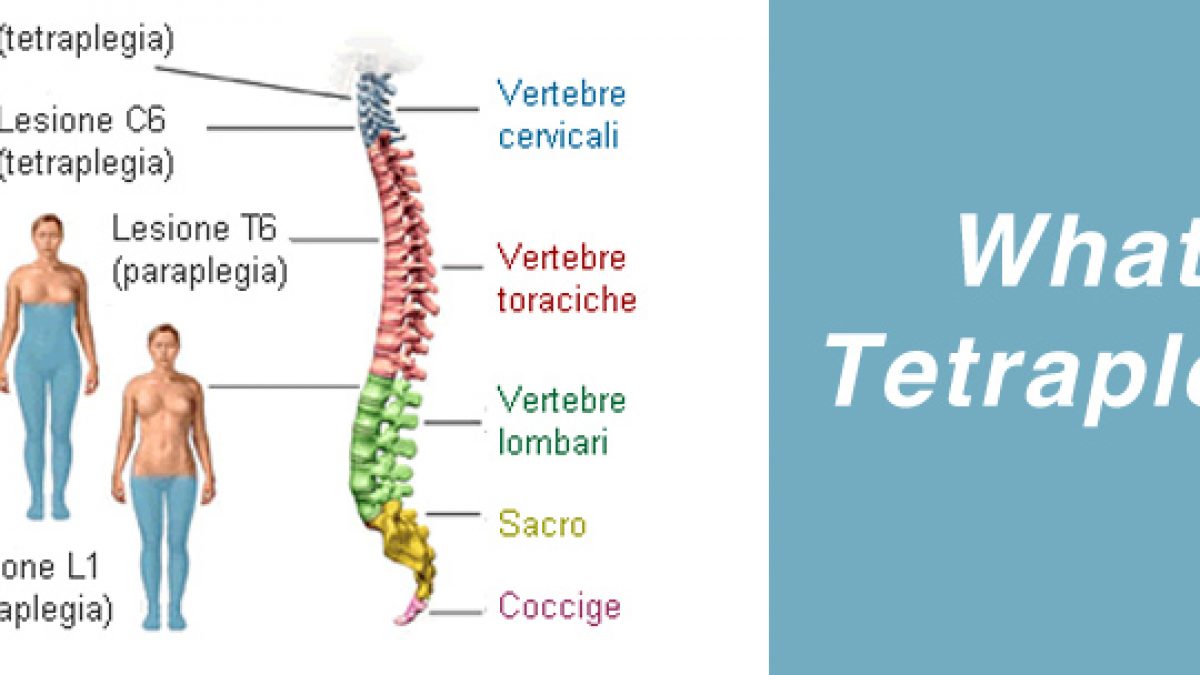 Параплегия. Квадриплегия с5/6. Квадриплегия (quadriplegia). Tetraplegia what. Квадриплегия речь.